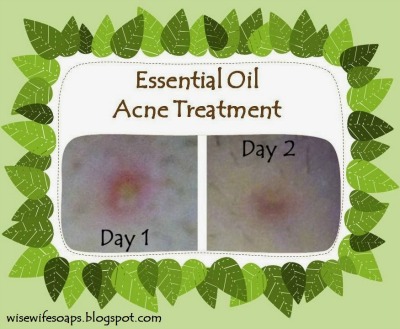 How to Make a DIY Acne Treatment with Essential Oils that Works
