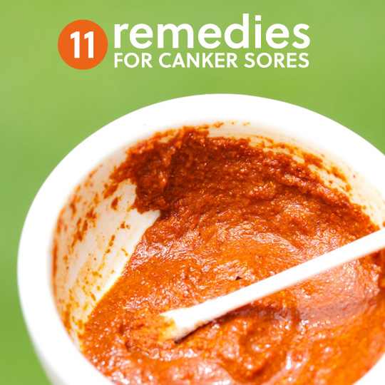 11 Natural Remedies for Canker Sores