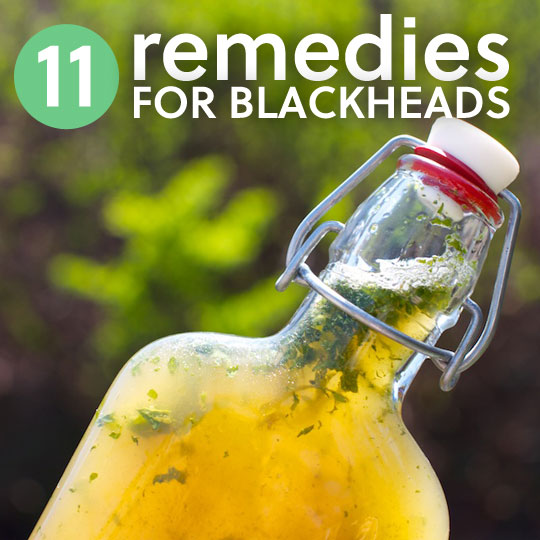 11 Remedies for Blackheads