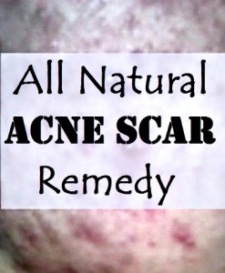 DIY All Natural Acne Scar Recipe