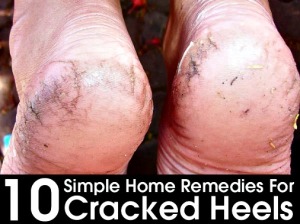 10 Simple Home Remedies For Cracked Heels